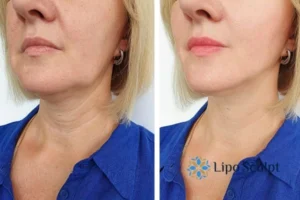 Double chin before and after Hi-Fu treatment 4 Book your double chin treatment Cardiff today! We are here to help!