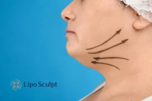 Double chin before and after Hi-Fu treatment 3 Boost your confidence with a Double chin treatment Cardiff