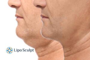 Double chin before and after Hi-Fu treatment 2 Double chin treatment Cardiff from Lipo Sculpt - feel more confident today!