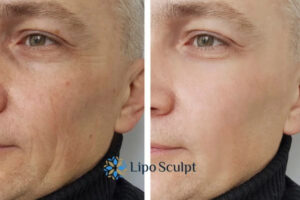 How to Fight Aging Symptoms 3 Fight Aging Symptoms Cardiff With HIFU and Morpheus8 Today!