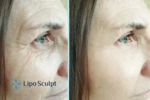 How to Fight Aging Symptoms 2 Do you want to Fight Aging Symptoms Cardiff? Contact Lipo Sculpt today!