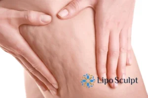 CoolSculpting for Legs: The Innovative Approach to Redefining Your Legs 5 Start your journey today book your coolsculpting treatment Cardiff online today!