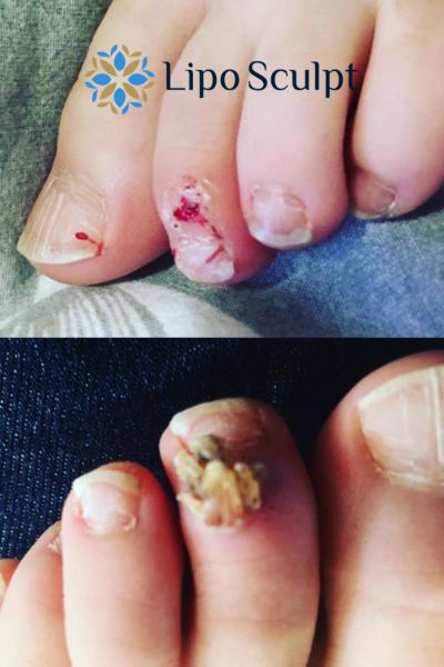 Wart removal customer results from Lipo Sculpt Cardiff