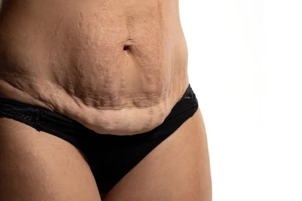 Lost the Weight but Not the Loose Skin? 1 image of womans stomach after weight loss showing loose skin Cardiff